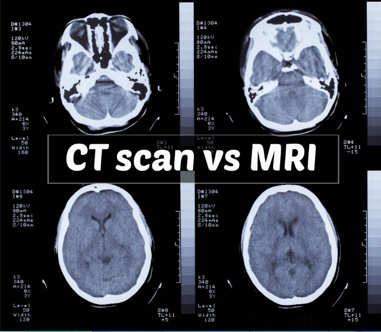 Comparing MRI and CT in Personal Injury Cases - Precise Imaging